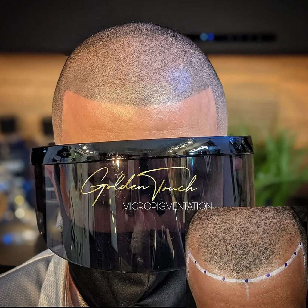 sharp hairline before and after