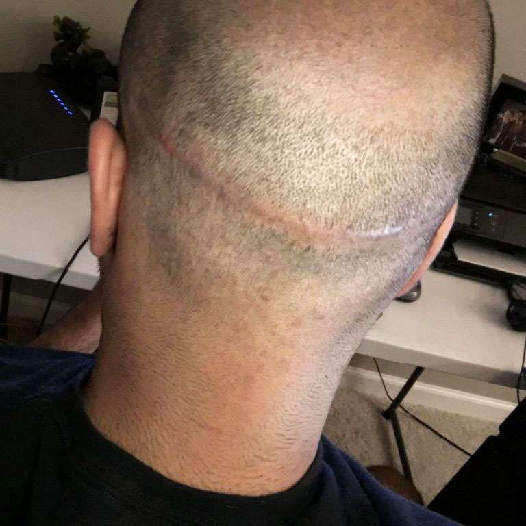 scarring from transplants
